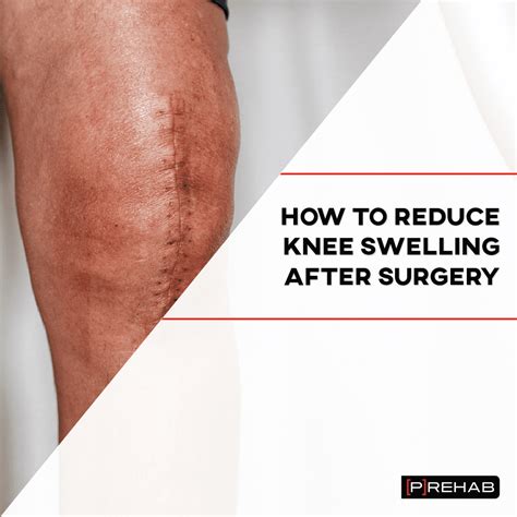 How Long Does Swelling Last After Knee Replacement Surgery - Infoupdate.org