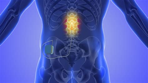 Spinal Cord Stimulation - Montana Advanced Pain & Spine