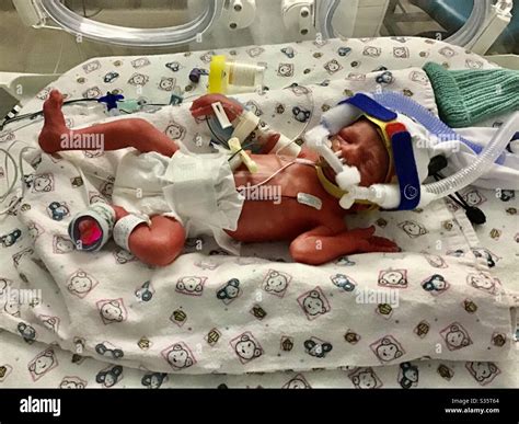 Download Pictures Of Premature Babies at Michael Mullett blog