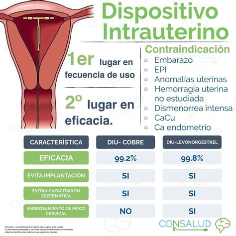 Dispositivo Intrauterino Anticonceptivo