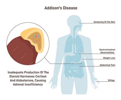 Premium Vector | Addison's disease symptoms of chronic adrenal insufficiency or hypocortisolism