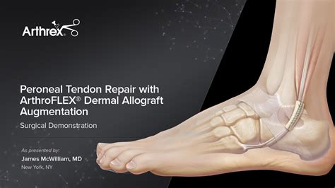Peroneal Tendon Repair