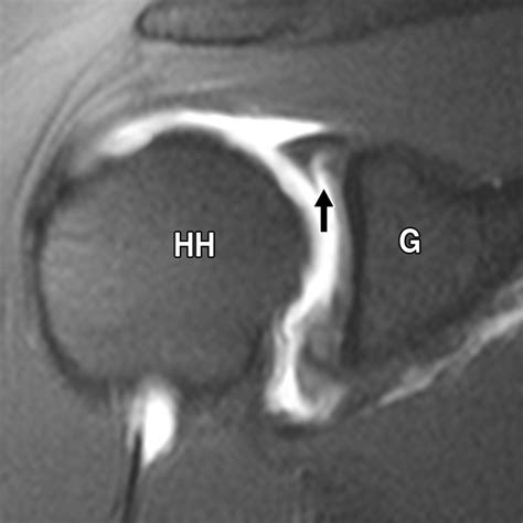 Superior Labral Anteroposterior Lesions of the Shoulder: Part 1 ...