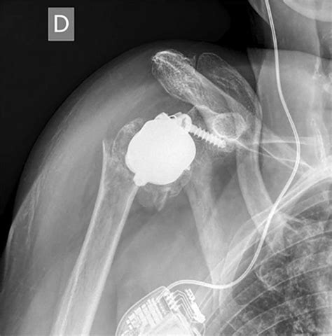 Patient-specific lateralization, glenoid offset, implications and oper ...