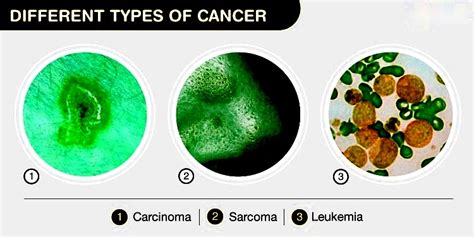 Types of Cancer Names 的图像结果