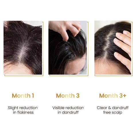 Ultimate Anti-Dandruff Serum for a Healthy Scalp – The Skin Story