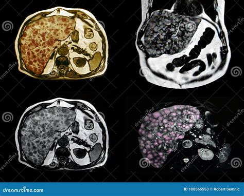 Liver metastasis MRI stock illustration. Illustration of lies - 108565553