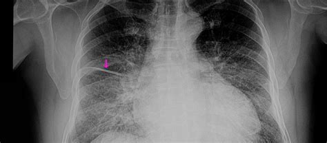 Chest X Ray Pulmonary Edema