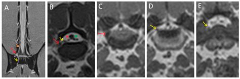 Conjoined Lumbosacral (L7-S1) Nerve Roots in a Dog