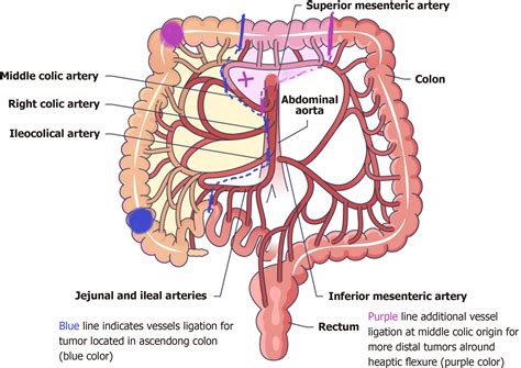 Laparoscopic right radical hemicolectomy: Central vascular ligation and ...