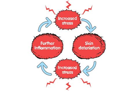 Eczema Stress And Anxiety