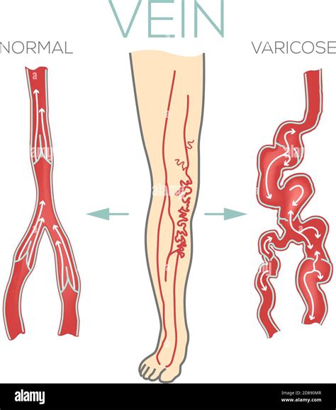 Varicose veins, large, swollen vein on the legs and feet. Valves do not work, blood does not ...