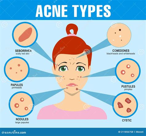 Types Of Blackheads, Pustule, Acne. Scarred Skin After Acne And Acne. Infographics. Vector ...