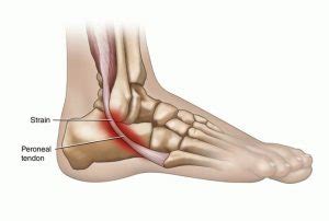 Tendon problems in the ankle joint | Buxton Osteopathy Clinic