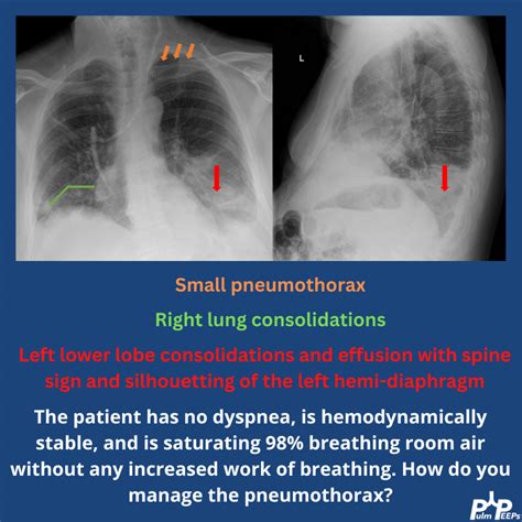 Lung Consolidation Vs Pleural Effusion