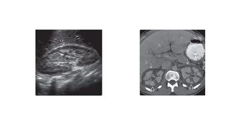 RENAL PARENCHYMAL DISEASE IMAGING.pptx