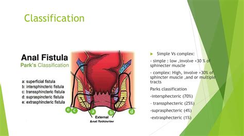 Fistula Perianal O Anal: Síntomas, Causas Y Tratamiento – RRXTV