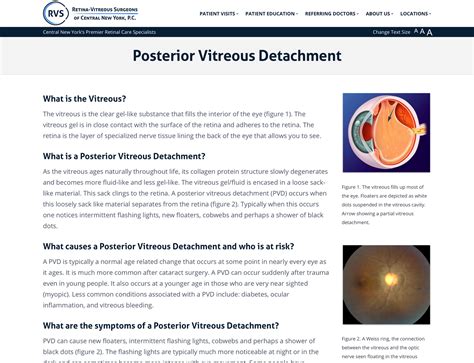 Posterior Vitreous Detachment Signs Causes Treatment Posterior
