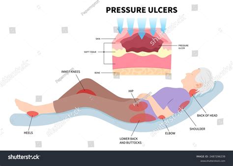 Bed Sores Pressure Ulcer Causes Stages Prevention