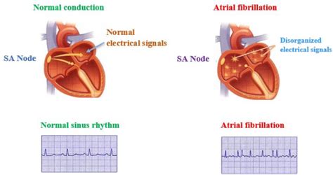 Atrial Fibrillation 的图像结果
