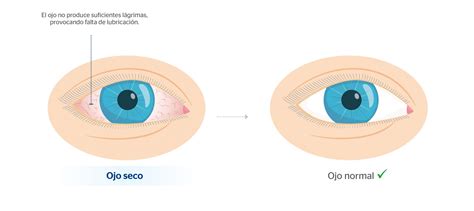 Ojos rojos: causas y soluciones - Blog de Clínica Baviera