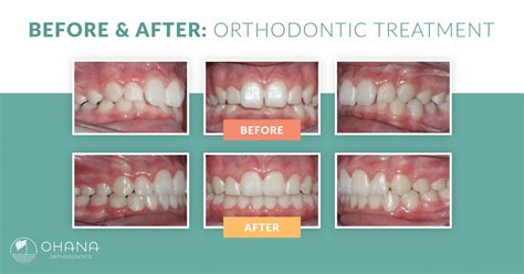 Braces Before and After: How Can They Help Your Smile? - Ohana Orthodontics Canby, OR