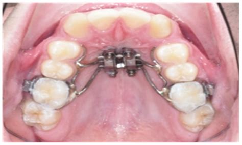Skeletal, Dentoalveolar and Dental Changes after “Mini-Screw Assisted Rapid Palatal Expansion ...