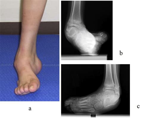 Management of foot deformity in children - Journal of Orthopaedic Science