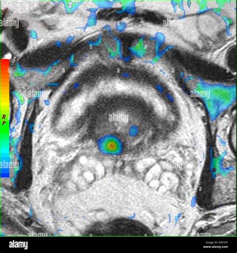 Colored MRI (Magnetic Resonance Imaging) showing a prostate cancer seen ...