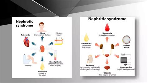 Nephrotic vs nephritic.pptx