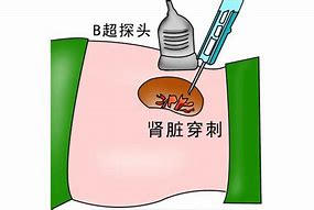 Image result for percutaneous 经皮穿刺肾脏切片术