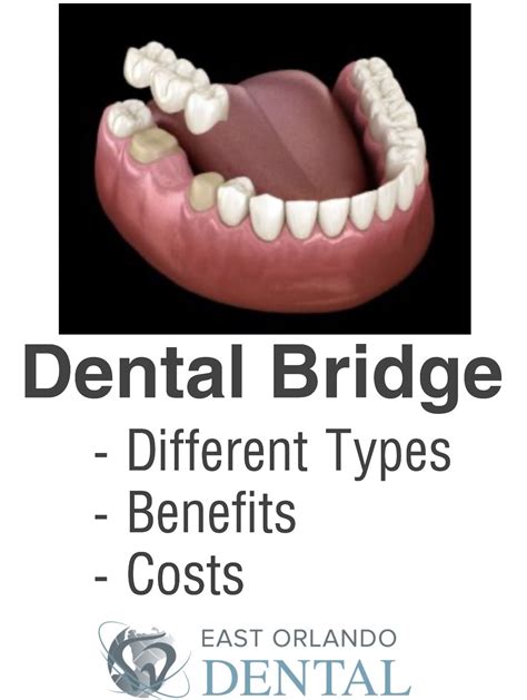 Dental bridge types benefits cost – Artofit