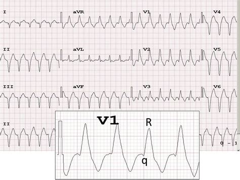 Does Tachy Brady Syndrome Have Wide Qrs at Kate Terry blog