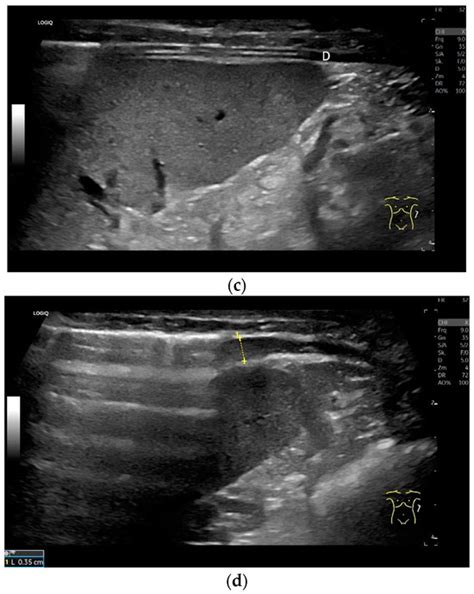 The Perception of the Diaphragm with Ultrasound: Always There Yet ...