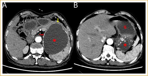 Gastric duplication cyst with extensive calcification in the wall - The American Journal of the ...