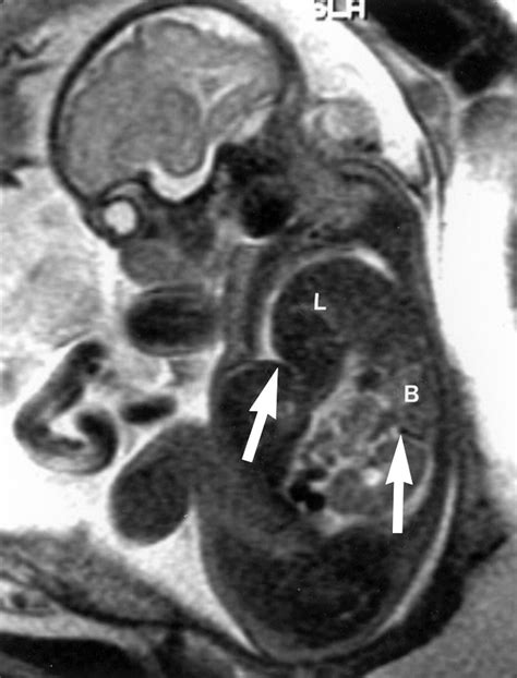Congenital Diaphragmatic Hernia Mri Congenital Diaphragmatic Hernia