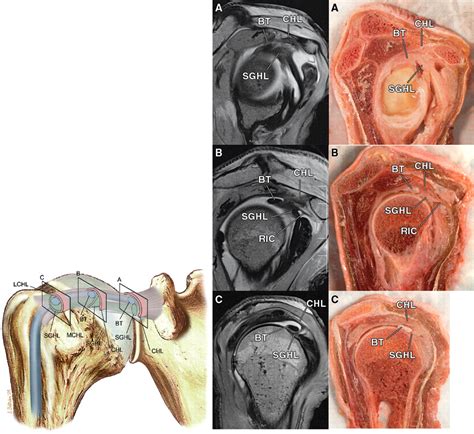 Rotator Interval Capsule Anatomy at Benjamin Ferguson blog