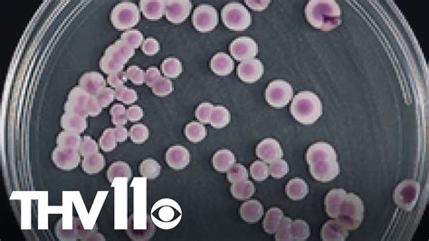 No cases of Candida Auris in Arkansas, officials say | thv11.com