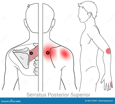 Serratus Posterior Superior Muscle Trigger Points Stock Illustration ...