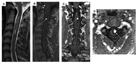 Diagnostic and Therapeutic Approaches for Spinal Subarachnoid ...