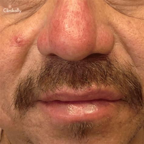 Rhinophyma (Nose Swelling): Causes and Treatment Options | Clinikally