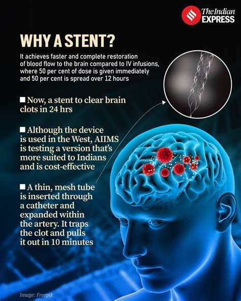 Hope for brain stroke patients: How a stent can clear blood clots in 24 hours | Health and ...
