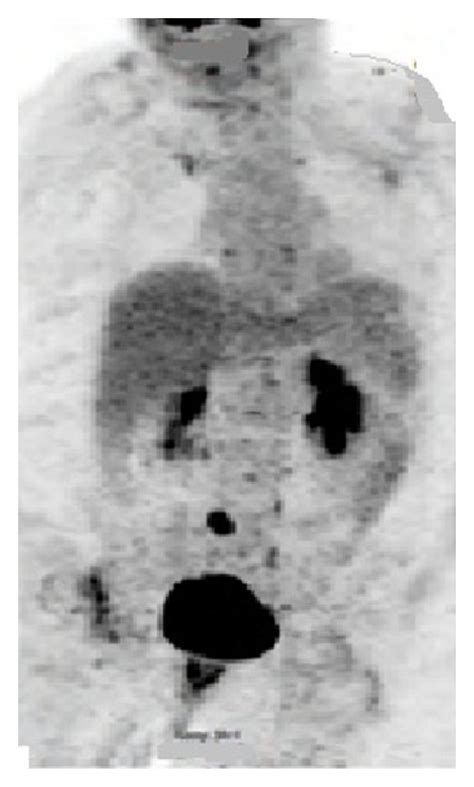 Kuvatulokset haulle pericolonic lymph nodes