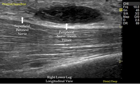 Peripheral Nerve Sheath Tumor