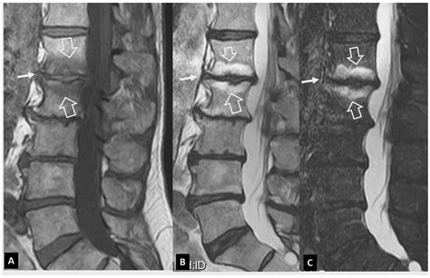 Musculoskeletal Infection: The Great Mimickers on Imaging