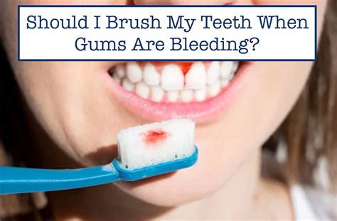 What To Do If My Gums Bleed When Brushing Teeth | Detroit Chinatown