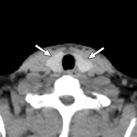 Normal Thyroid Gland