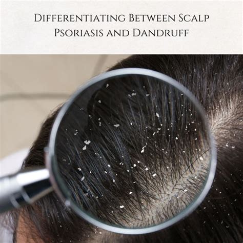 Scalp Psoriasis vs. Dandruff: Treatment & Symptoms | Clinikally