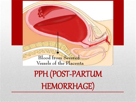 POST PARTUM HEMORRHAGE PPH POST PERTUM DELIVERY | PPTX