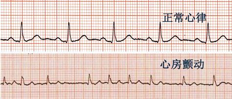 心电图图例分析：心房颤动、三度房室传导阻滞、交界性逸搏心律 - 爱爱医医学网